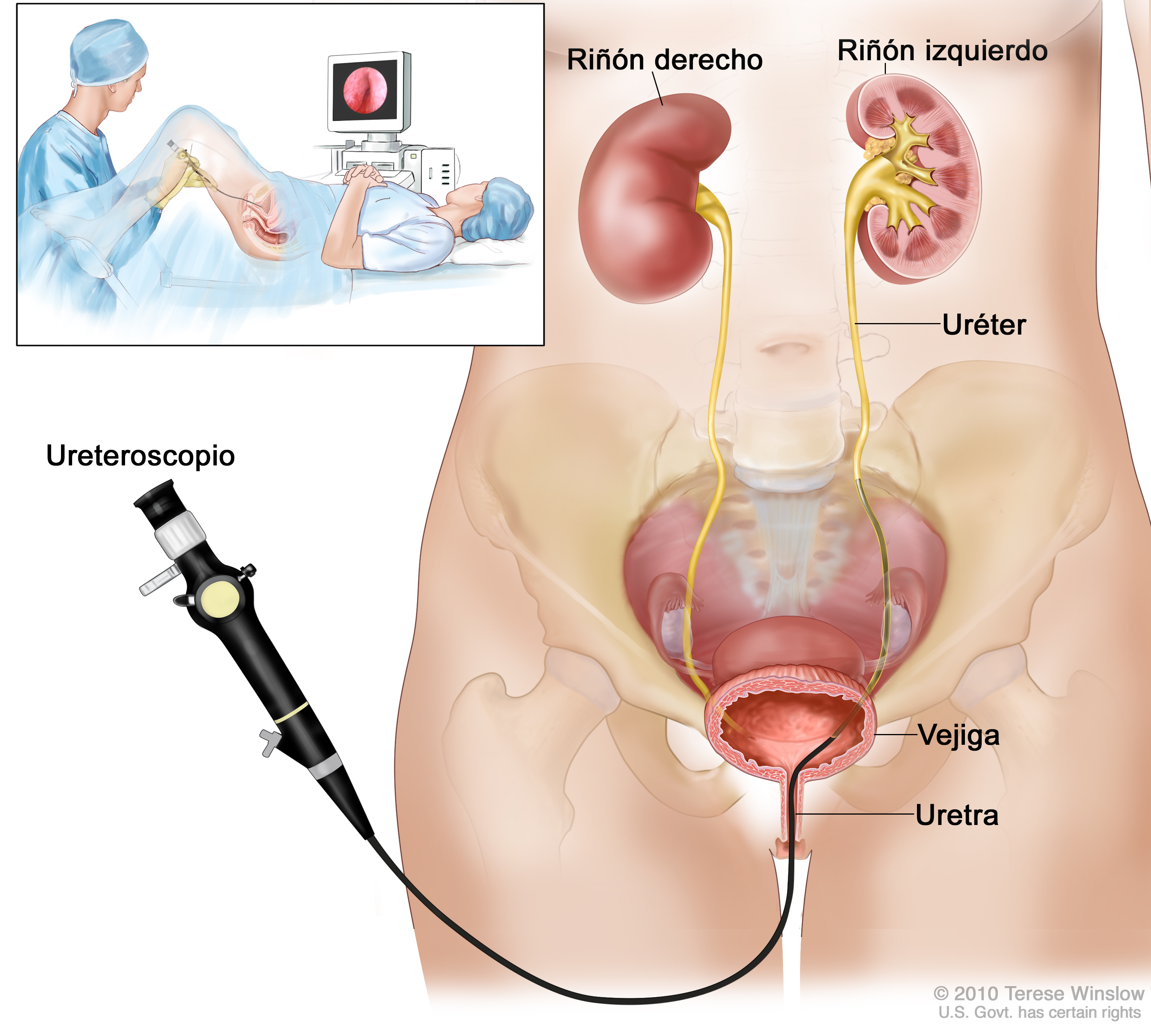 calina Asesinar Estricto CIRUGIA ENDOSCOPICA DE URETER: Tratamiento de cálculos renales sin cortes.  Lima - Perú | Centro de Cirugía por Endoscopia en el Perú